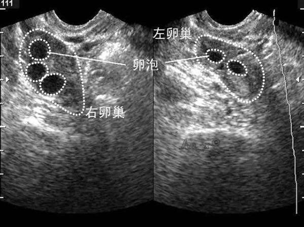 成熟卵泡和优势卵泡的区别