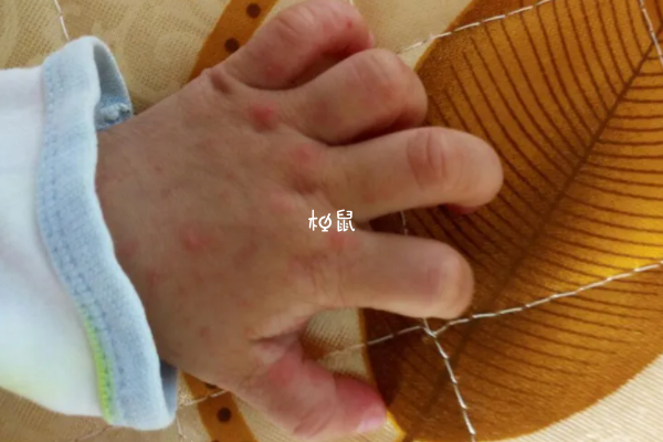 患有手足口病不要吃刺激性强的食物