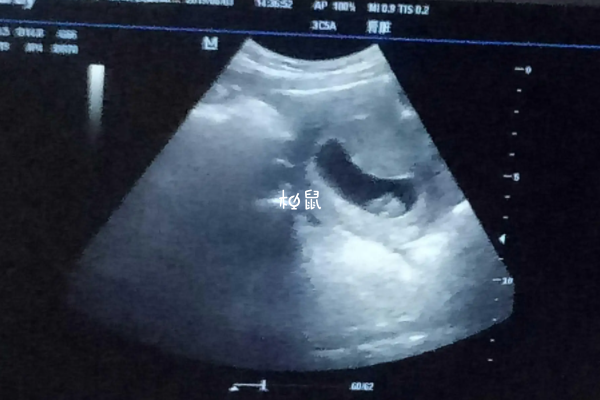 生男孩的孕囊是长条形的