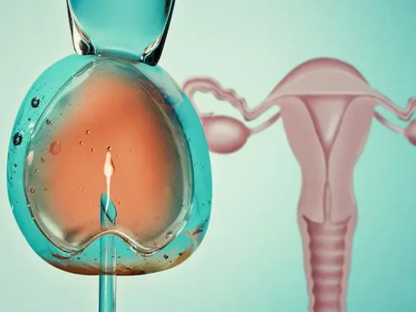 单精子注射费用约5000元