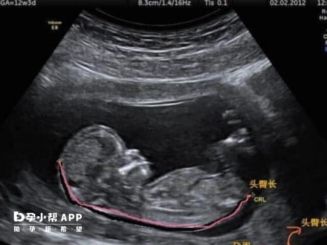 通过胎儿头臀长判断生男生女