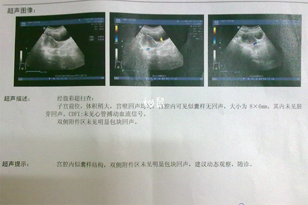 B超孕囊可以看出女孩