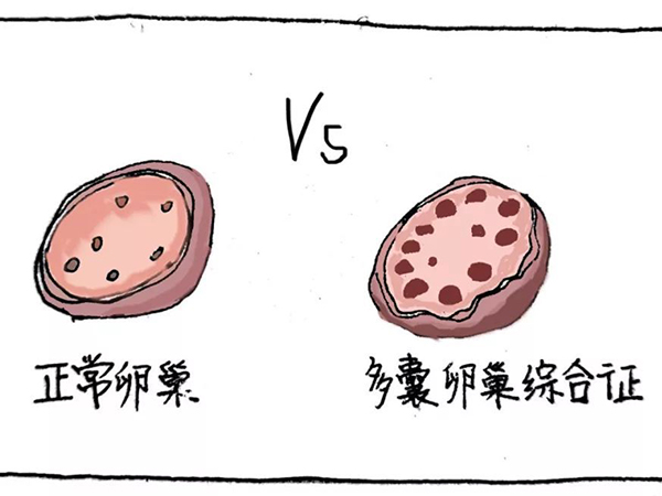 多囊卵巢不利于怀孕