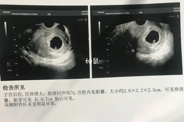 XX孕囊和XY孕囊形状差异不大