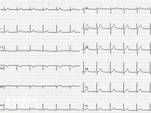 做试管心电图不合格调理办法