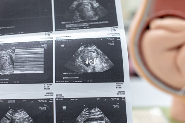 怀孕早期做B超需要憋尿