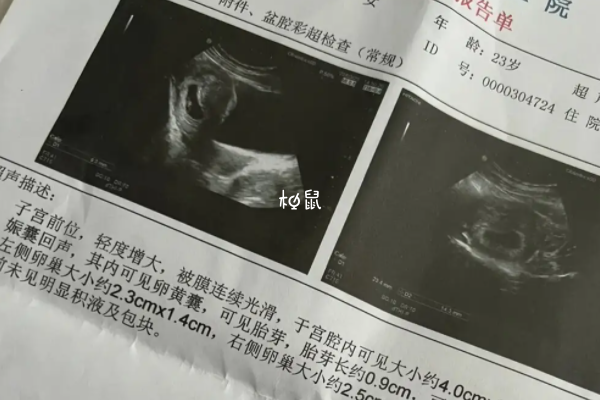 胎动停止说明可能胎停了