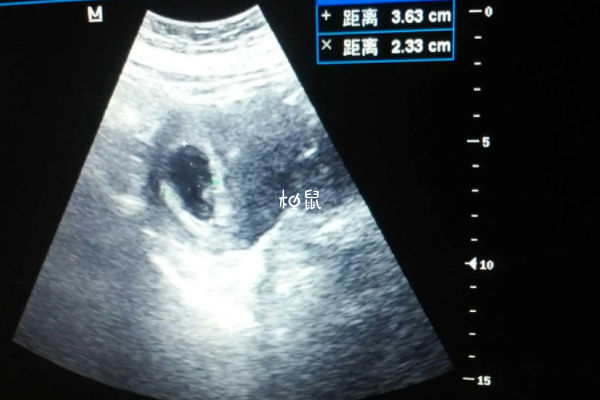 孕囊偏左看不出性别