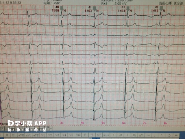 心电图对做试管的重要性