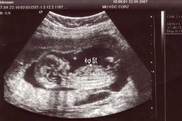 B超有两点不一定是男孩
